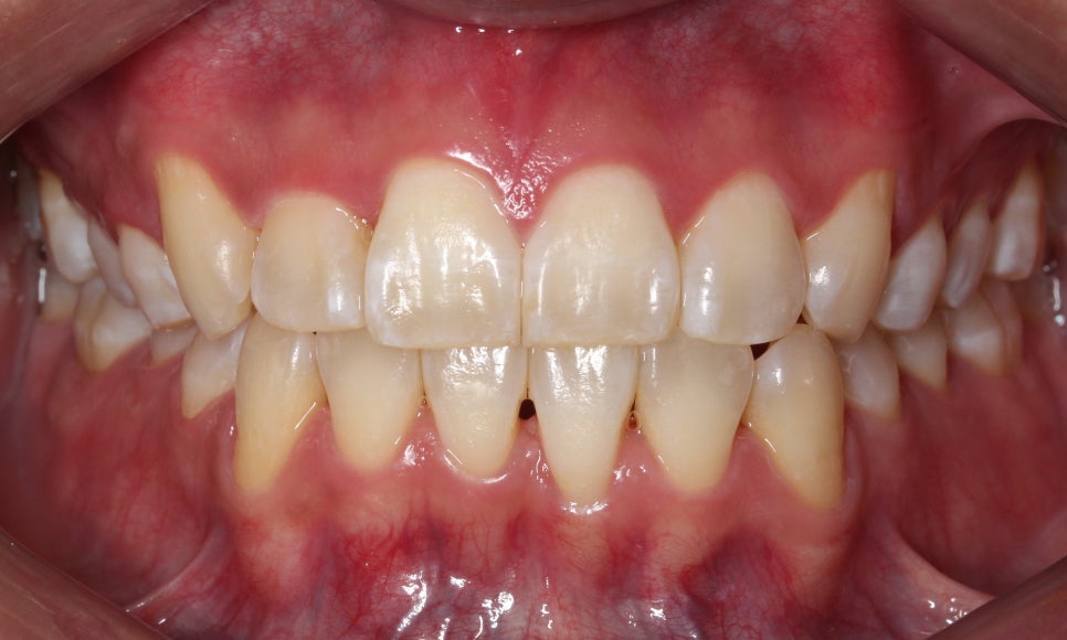 앞니 덧니 고민, 부분 설측 교정으로 해결한 사례 관련 이미지 13