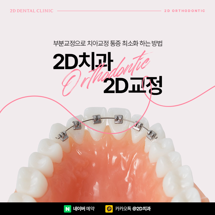 치아교정 통증 줄이는 방법, 부분교정으로 고통 최소화 관련 이미지 1