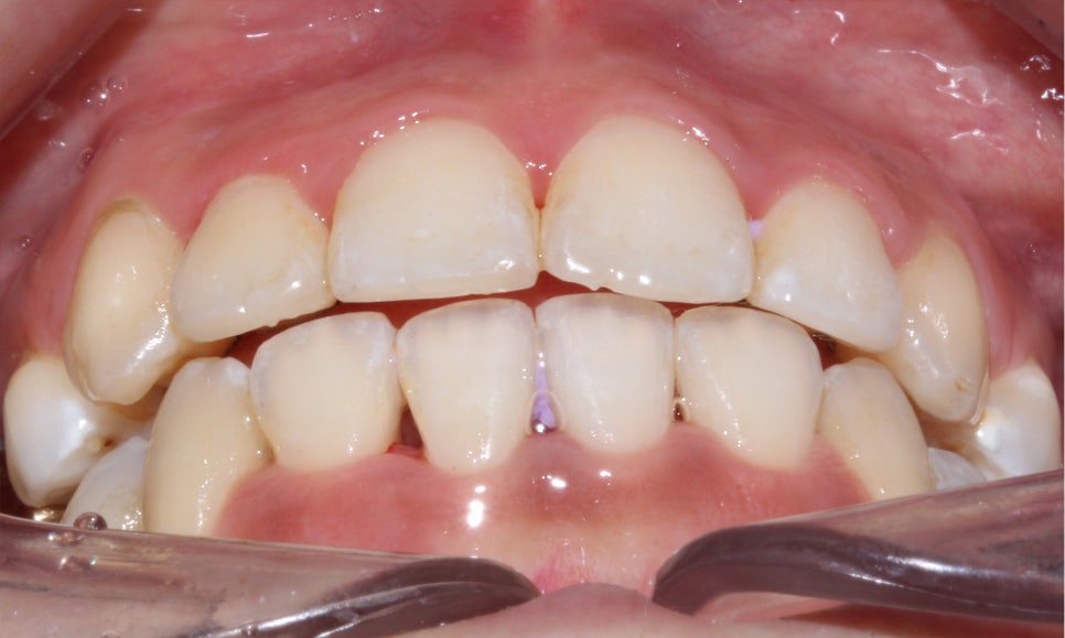 crowding 송곳니덧니 세라믹교정 방법 관련 이미지 10