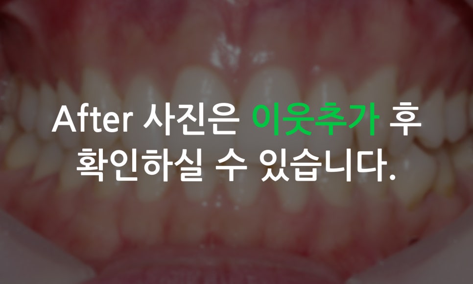 앞니틀어짐 2D교정으로 한번에 끝내는 방법! 관련 이미지 8