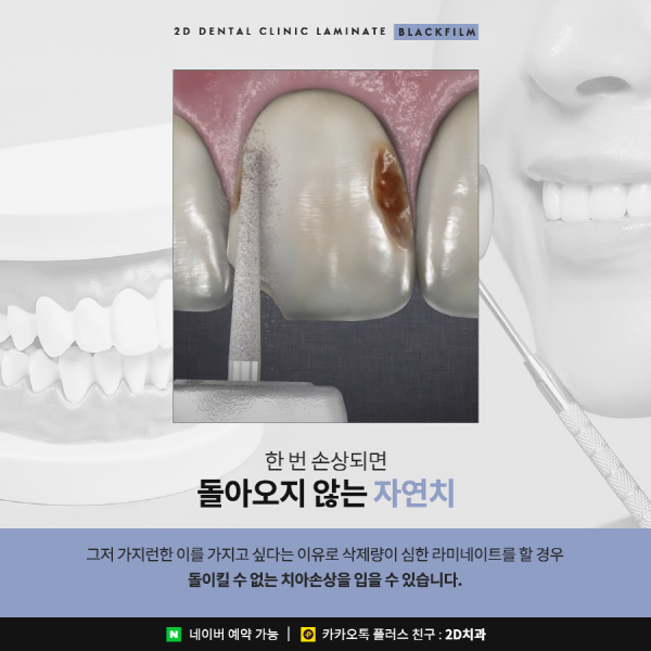 치아 삭제 없는 앞니 무삭제 라미네이트 <블랙필름> 관련 이미지 2