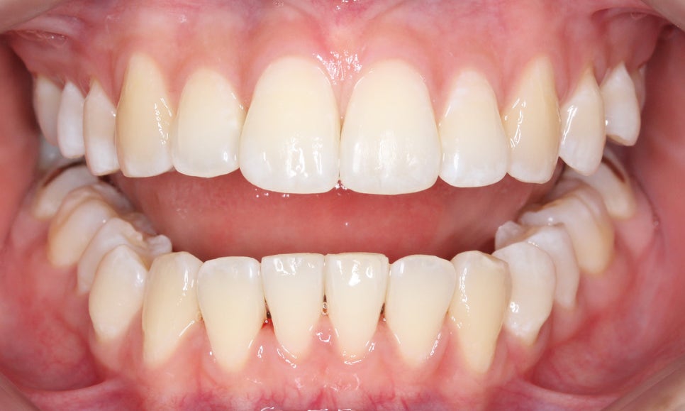 신논현치과 자가결찰브라켓 장점 관련 이미지 10