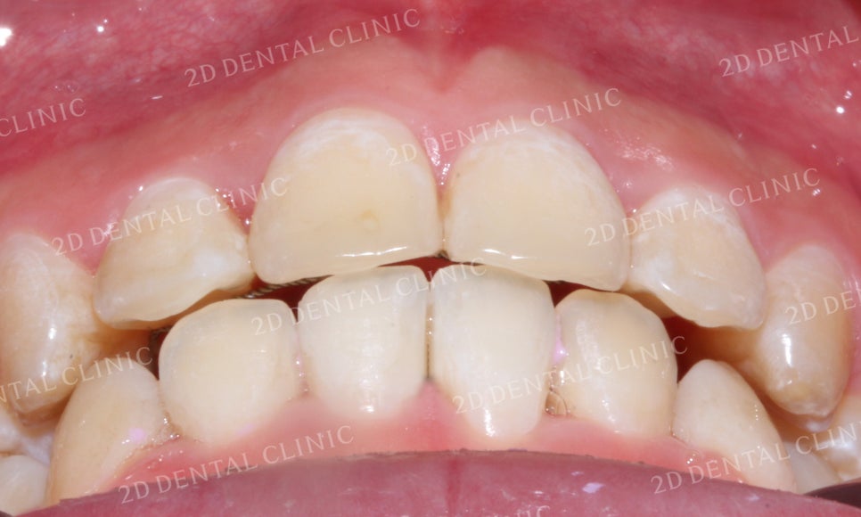 돌출앞니 교정, 튀어나온 입을 넣어보자! by.투디치과(2D치과) 관련 이미지 19