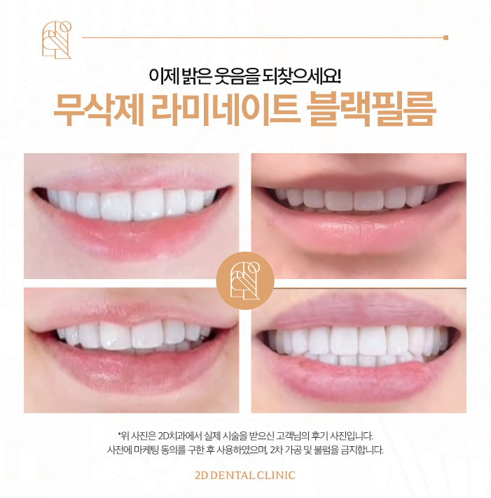 무삭제라미네이트가격 자신감 있게 활짝 웃는 방법 관련 이미지 7