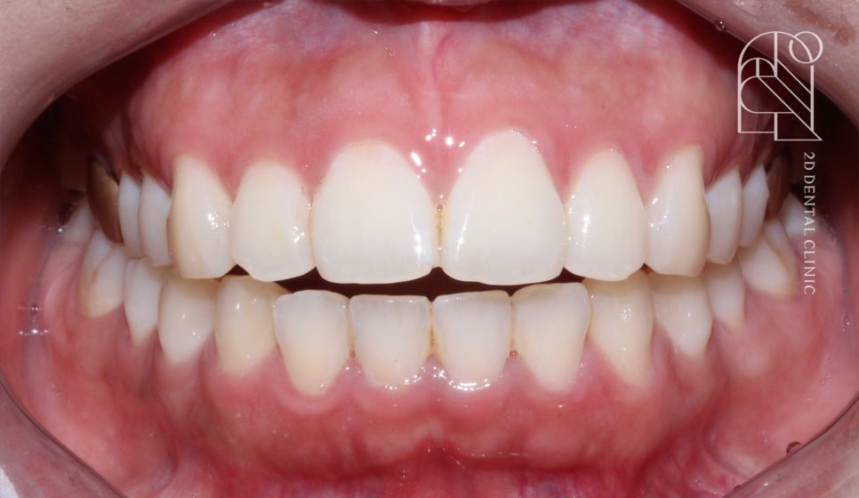 부정교합 치아교정, 전체교정으로 완성하기! by. 투디치과(2D치과) 관련 이미지 6