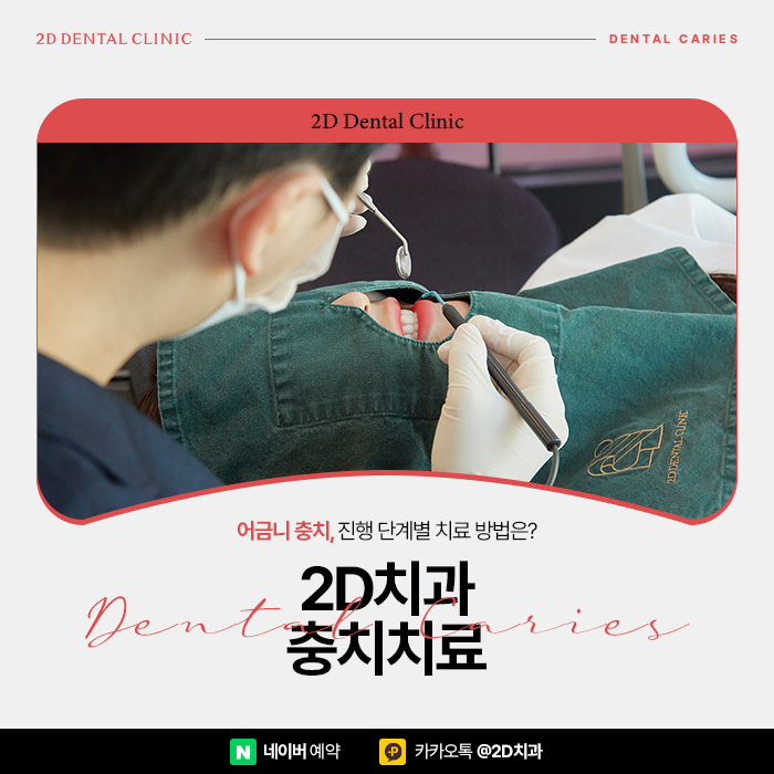 어금니충치치료 빠르게 진행해야 이유, 단계별 레진, 인레이, 크라운 순서 관련 이미지 1