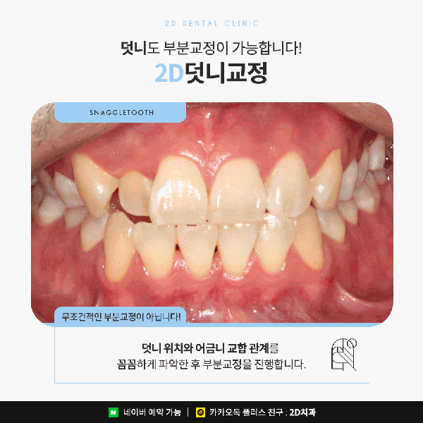 덧니가 두드러져 스트레스일 땐? 2D부분교정 관련 이미지 4
