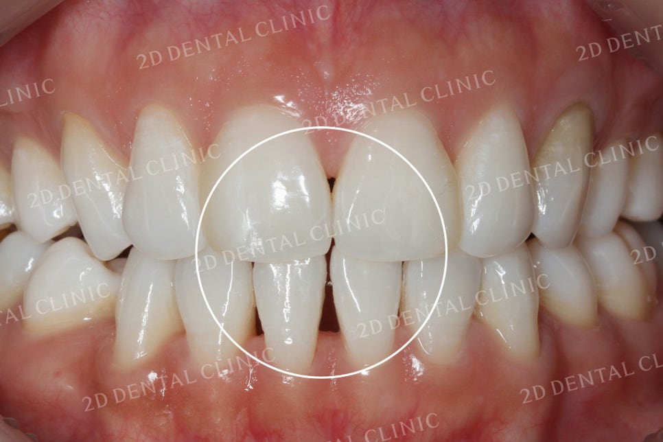 치아틈새를 완벽하게 메꾸자! 블랙트라이앵글 쎄라필름으로 완전 삭제! by.투디치과(2D치과) 관련 이미지 3