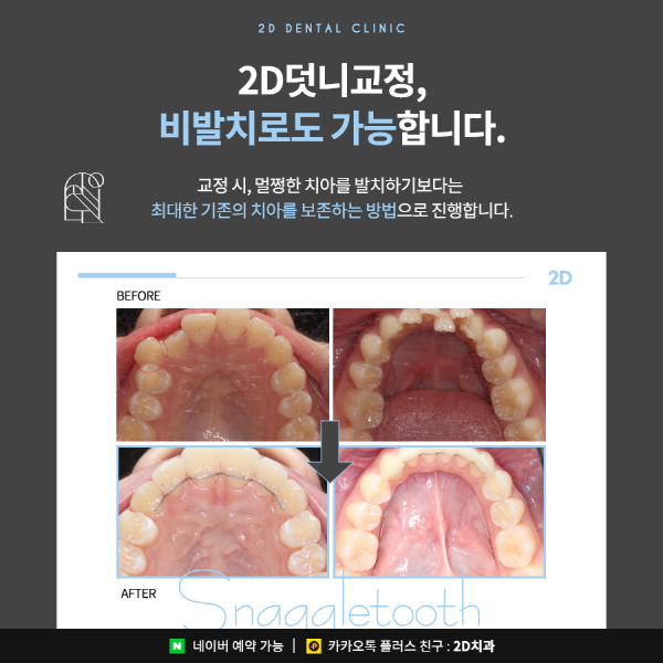 덧니가 두드러져 스트레스일 땐? 2D부분교정 관련 이미지 5