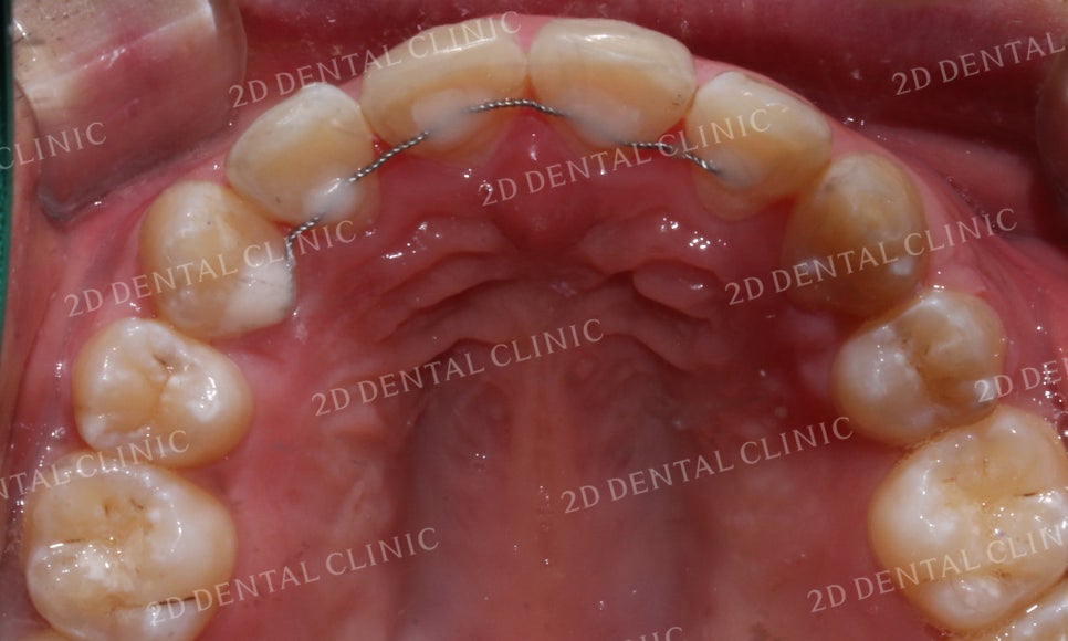 돌출앞니 교정, 튀어나온 입을 넣어보자! by.투디치과(2D치과) 관련 이미지 27