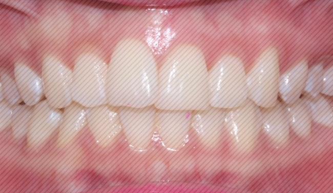 [신논현역치과] 앞니돌출 2D교정으로 개선! 관련 이미지 5