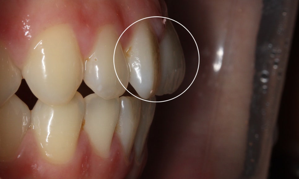 나비앞니 세라믹교정 case 관련 이미지 3