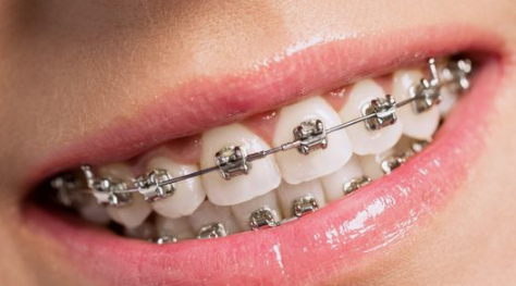 치아삭제 없는 블랙필름 무삭제라미네이트가격 관련 이미지 5