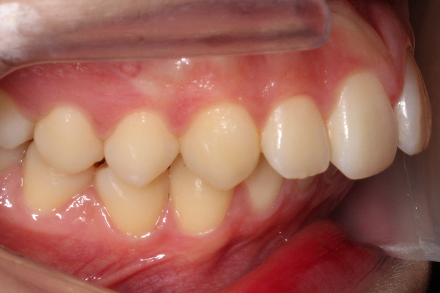 입돌출 데이몬교정 Case1 관련 이미지 4