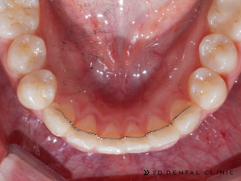 케이스로 확인하는 토끼이빨, 교정전문 2D치과 관련 이미지 12