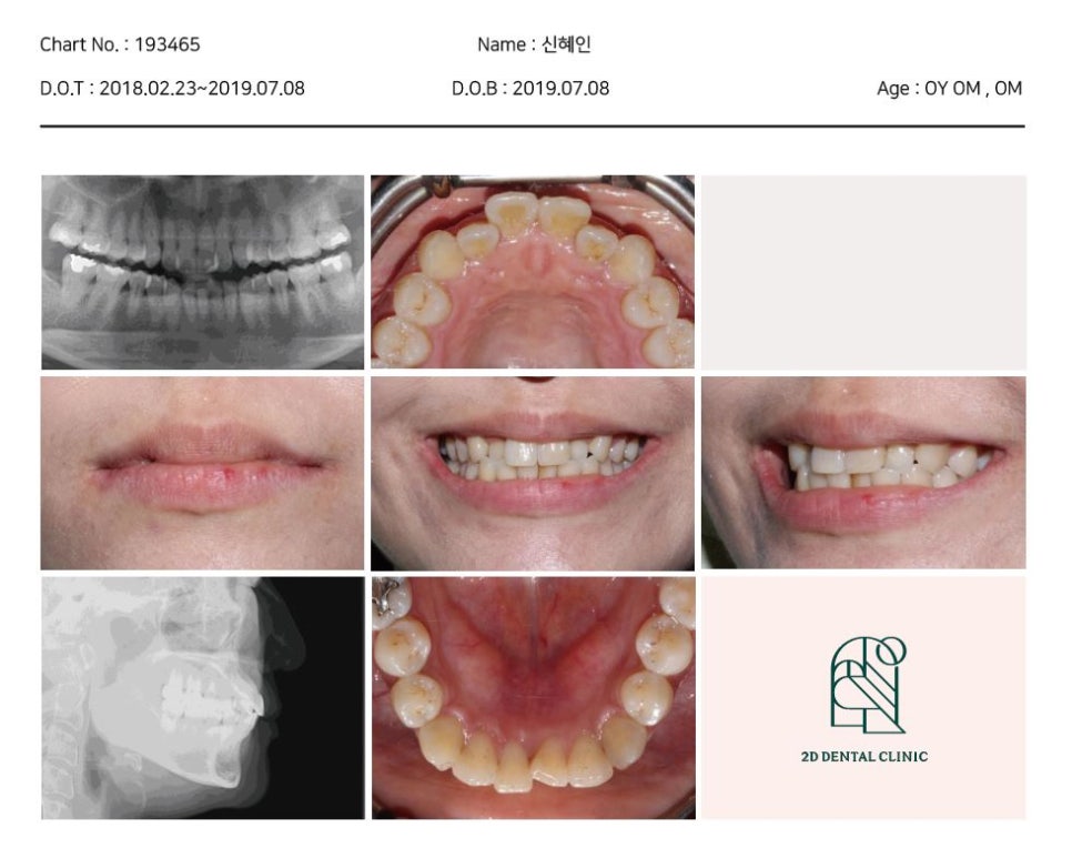 2D치과(투디치과) 교정일기ㅣ앞니덧니,반대교합 치아교정 완료!(ft.투디교정 전체교정) 관련 이미지 6