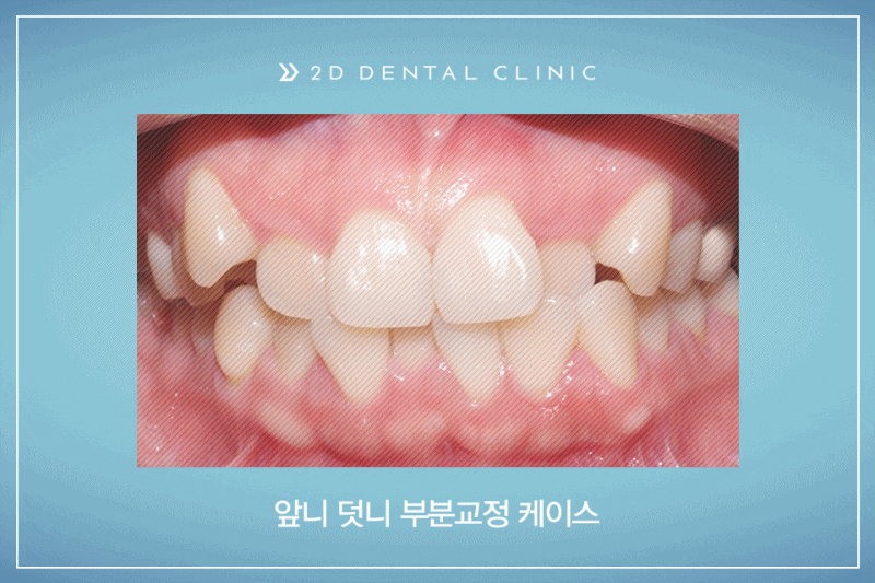 발치교정 돌출입 케이스, 교정전문 2D치과 관련 이미지 1