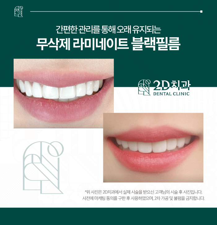 대전무삭제라미네이트 시술 후 간편하게 관리하세요! 관련 이미지 7