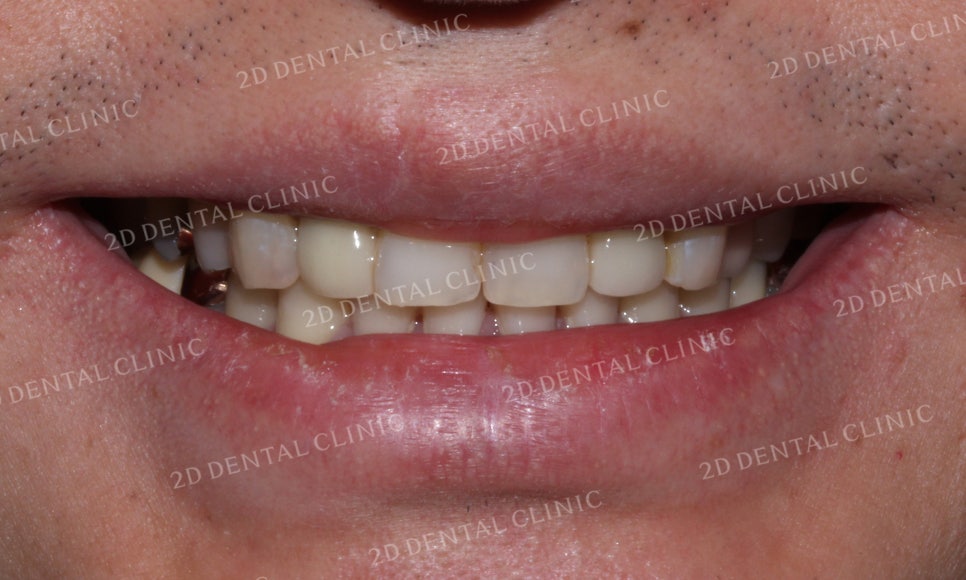 [2D교정] 나비치아교정을 2D교정 장치로 빠르게 완성하기! by.2D치과(투디치과) 관련 이미지 10