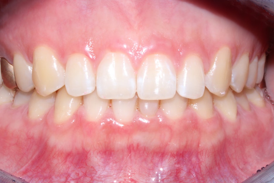 벌어진앞니 치간이개 공간 삭제하기! 관련 이미지 8