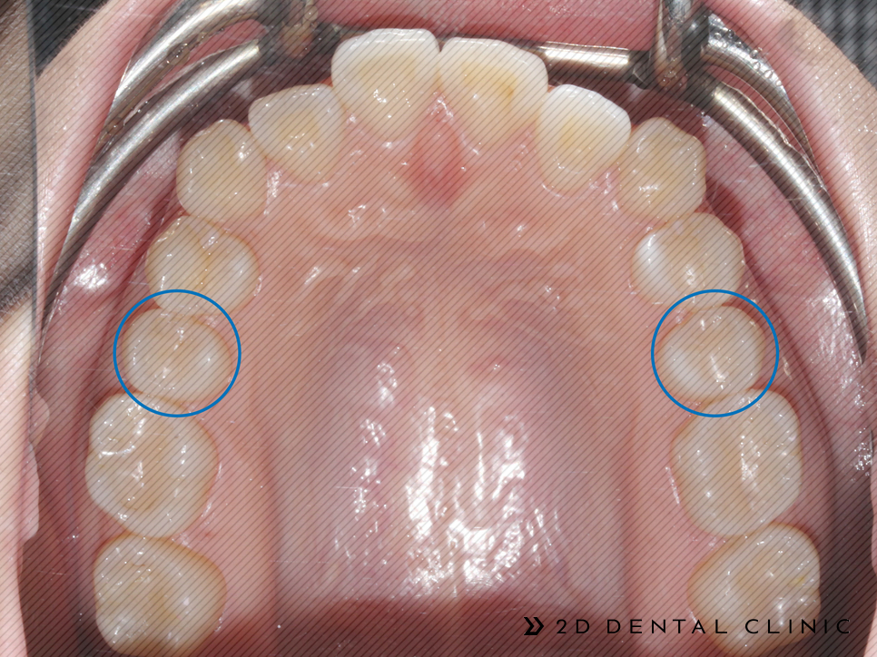절단교합 교정 케이스 전후비교, 교정전문 2D치과 관련 이미지 8