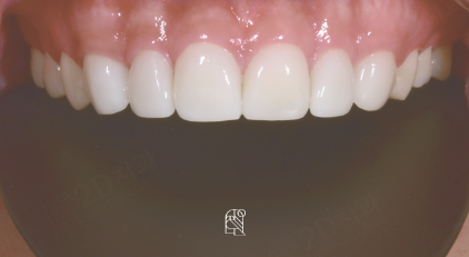 앞니왜소치 치아깨짐 무삭제라미네이트 블랙필름 관련 이미지 3