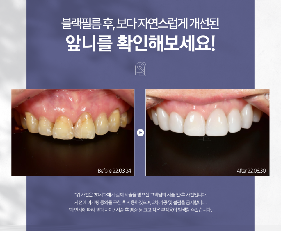 최준희라미네이트 치아착색 블랙필름으로 환해진 얼굴! 관련 이미지 7