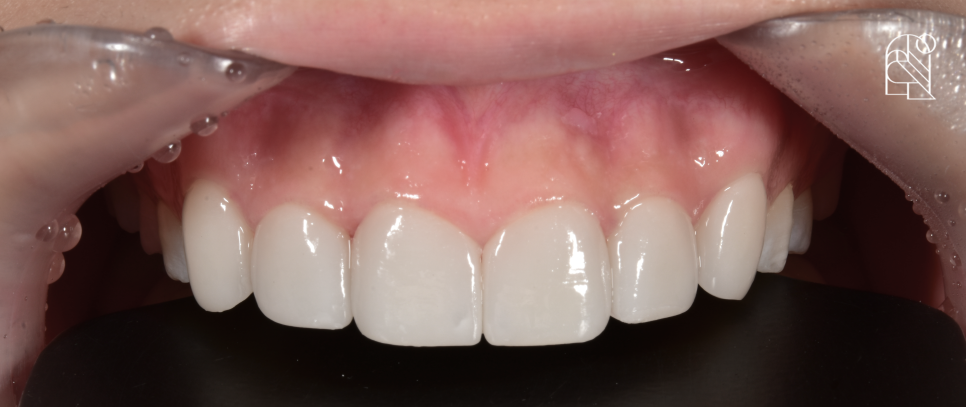 앞니깨짐 (앞니파절) 치료방법 세 가지 - 레진, 라미네이트, 크라운 관련 이미지 4