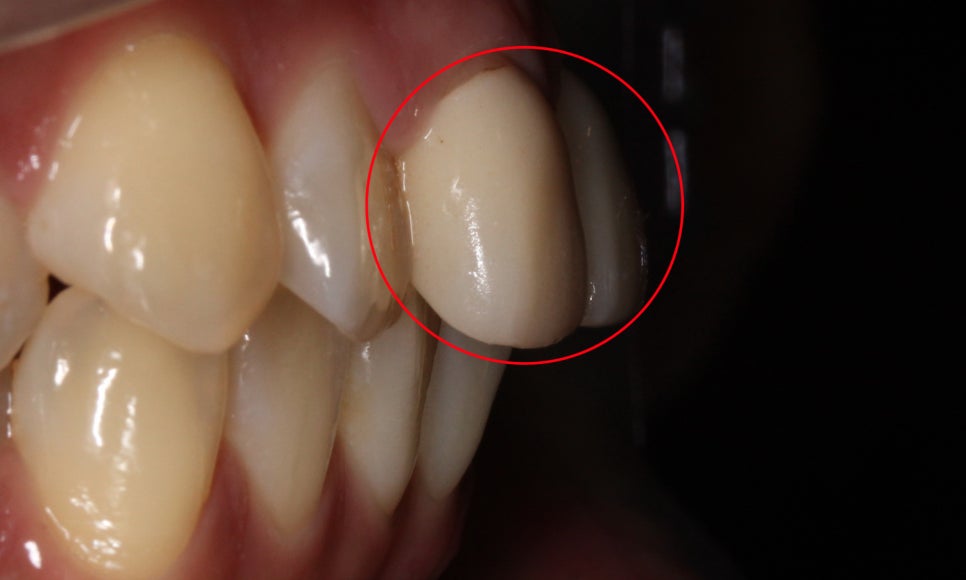 토끼앞니교정, PFM크라운 재보철을 동시에 치료하는 방법? 관련 이미지 3