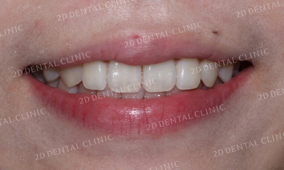 [앞니교정]토끼앞니교정, 부분교정으로 토끼이빨 탈출하기! by.투디치과(2D치과) 관련 이미지 8