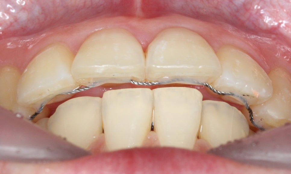 대치동치과 입툭튀 집어넣는 교정 관련 이미지 9