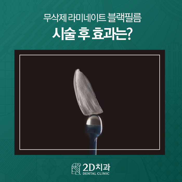 무삭제라미네이트 내 치아에 손상 없이! 관련 이미지 1