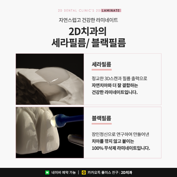 유난히 작은 치아 개선은? 2D 왜소치 라미네이트 교정 관련 이미지 6
