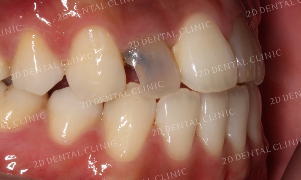 치아변색, 까맣게 변한 변색치를 블링스(Blinx)로 수복하기! by. 투디치과(2D치과) 관련 이미지 3