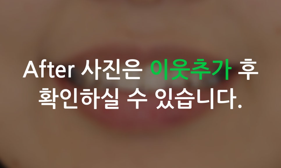 2D치과(투디치과)가 소개하는 토끼앞니 2D교정방법! 관련 이미지 6