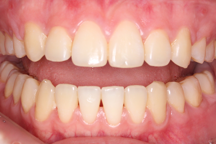 입돌출 데이몬교정 Case1 관련 이미지 9