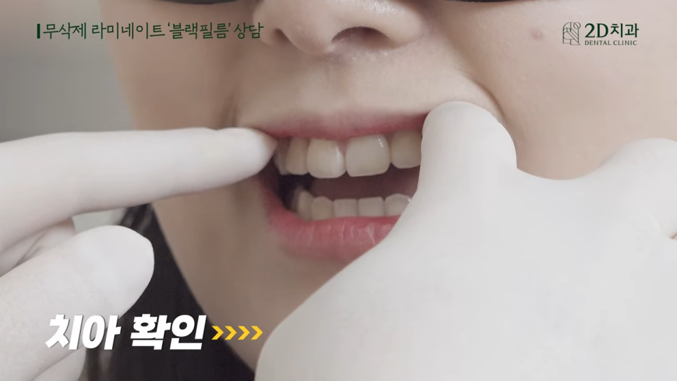 [블랙필름 상담받고 왔어요] #1 큰 앞니 작게 만들 수 있나요? 관련 이미지 7