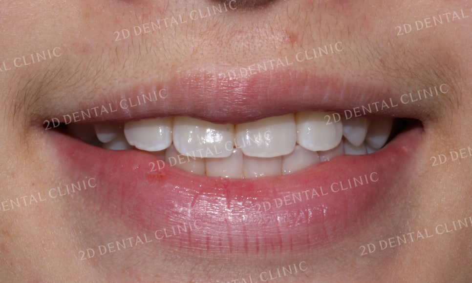 반대교합 치아교정, 앞니를 가지런하게! by.투디치과(2D치과) 관련 이미지 10