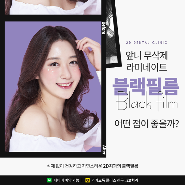 앞니 라미네이트 블랙필름의 효과성 A to Z 관련 이미지 1