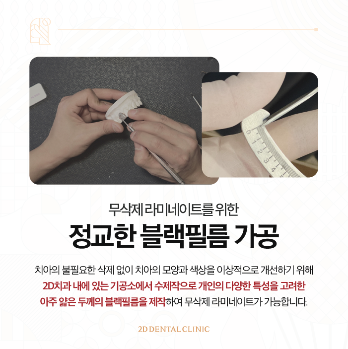 무삭제라미네이트비용 앞니 콤플렉스 극복은 블랙필름으로 관련 이미지 6