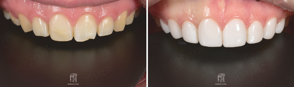 강남라미네이트치과 추천 : 진짜 무삭제, 투디치과! 관련 이미지 9