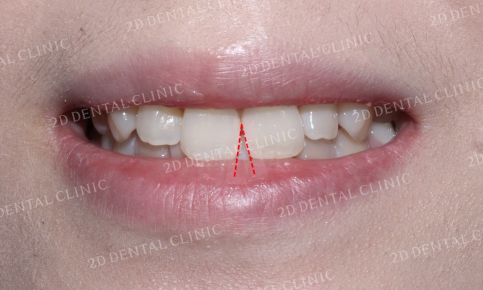 나비치아교정, 부분교정으로 나비치아 탈출하기! by.투디치과(2D치과) 관련 이미지 3