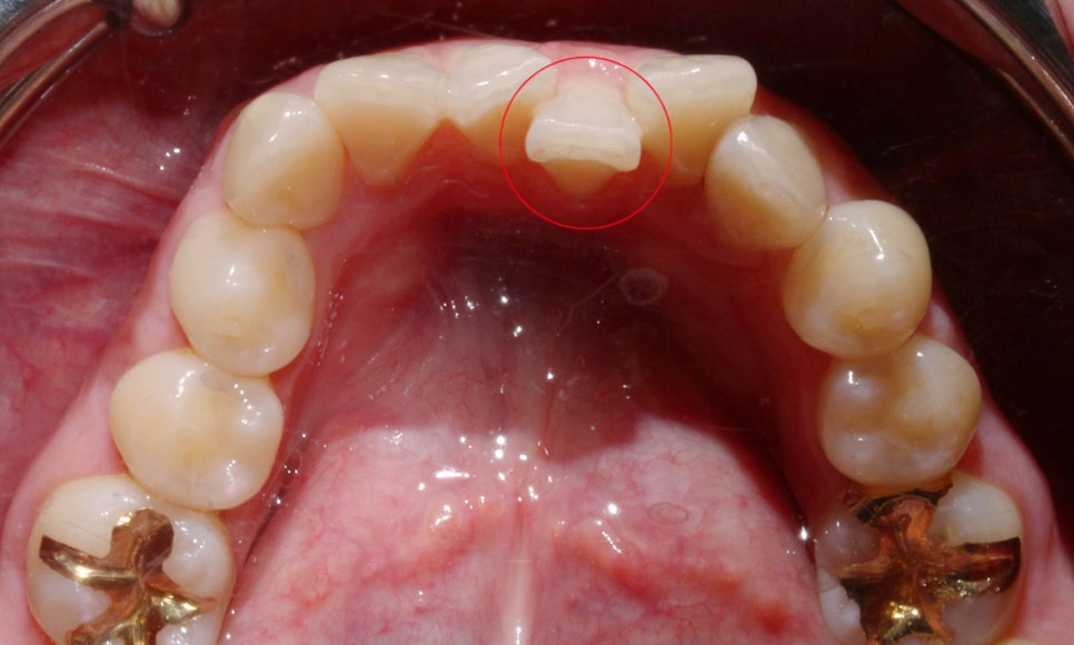 송곳니덧니 교정하는 방법! 관련 이미지 5