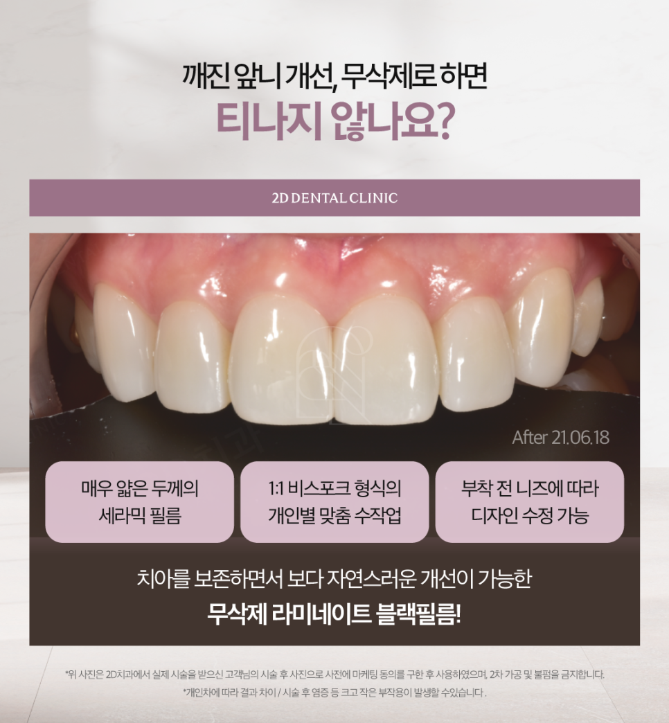 무삭제라미네이트비용 앞니살짝깨짐 더욱 큰 손상을 막기 위해서 관련 이미지 4