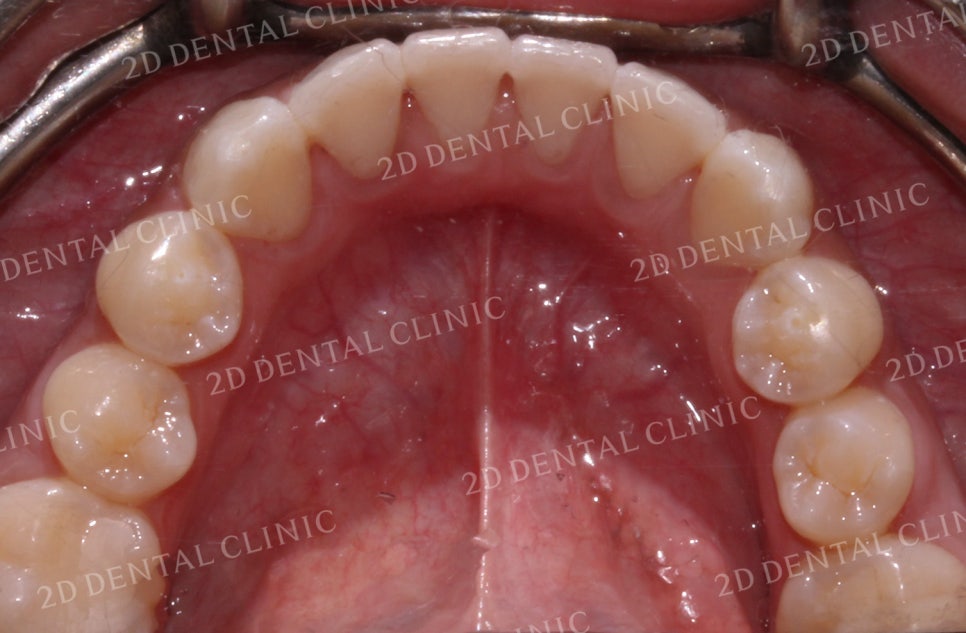 돌출입, 돌출앞니를 부분교정으로 고르게! by.투디치과(2D치과) 관련 이미지 15