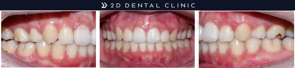 돌출입, 클리피씨로 교정기간과 통증을 최소화! 관련 이미지 5