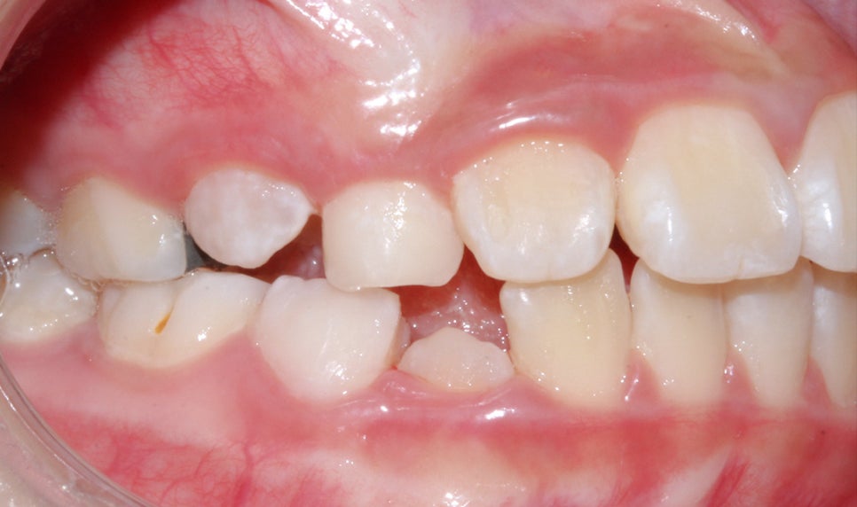 어린이 반대교합 덧니 교정으로 교정 끝! by. 투디치과(2D치과) 관련 이미지 4