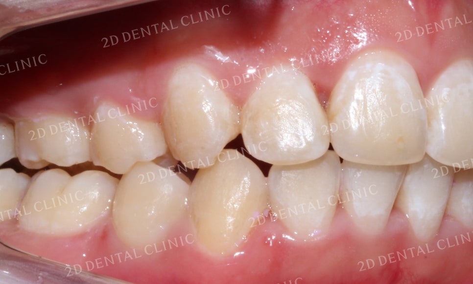 돌출앞니 교정, 튀어나온 입을 넣어보자! by.투디치과(2D치과) 관련 이미지 23