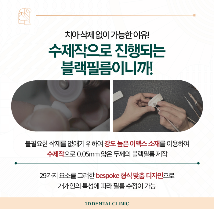 무삭제라미네이트 앞니성형 꼼꼼하게 진행하려면 관련 이미지 5