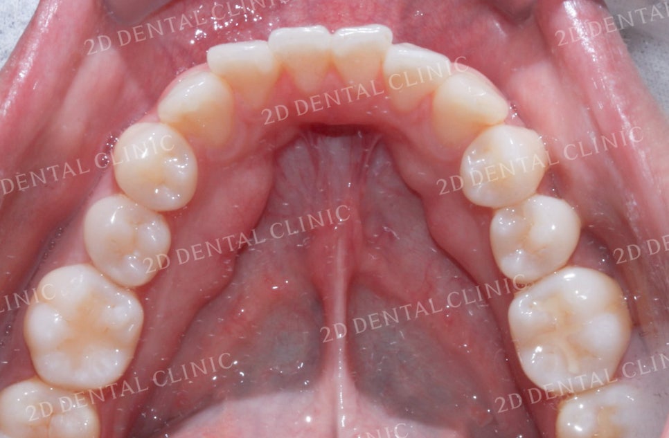 비대칭 앞니, 돌출앞니를 전체 교정으로 교정하고 싶다면!? by.투디치과(2D치과) 관련 이미지 15